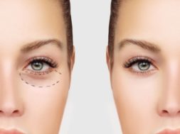 Marking the face.Lower-Eyelid Blepharoplasty