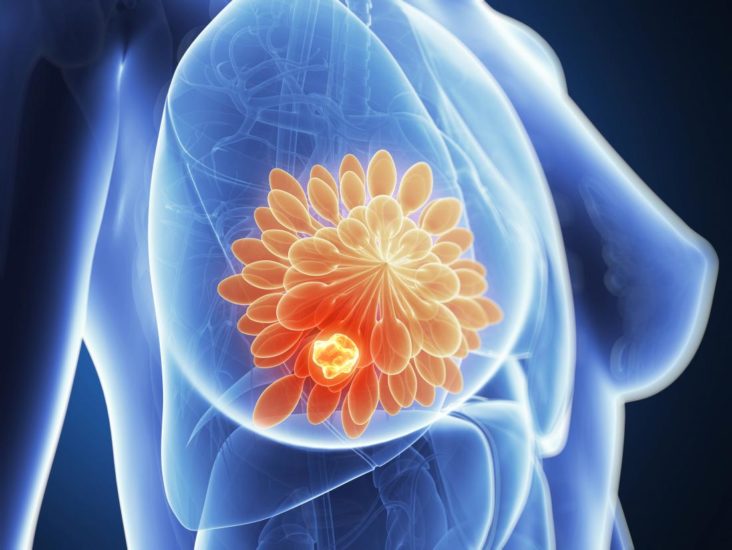 Νέα μέθοδος για την ανίχνευση καρκίνου του μαστού.