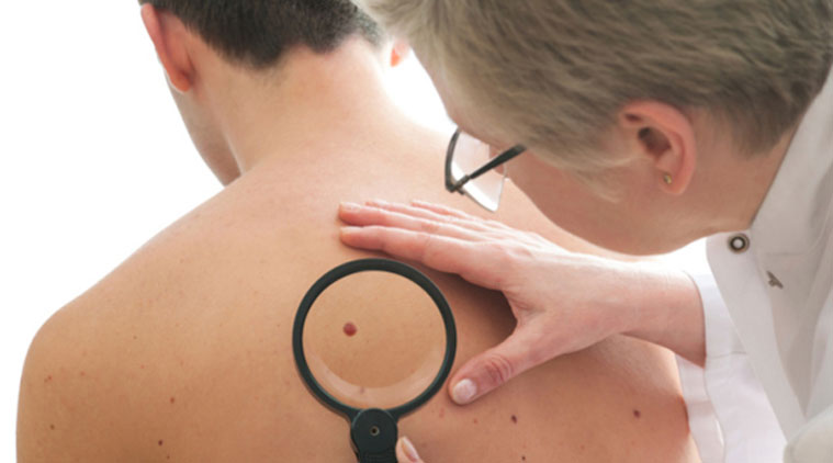 Νέες μελέτες για το μελάνωμα.