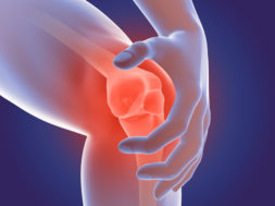 3D Render of Osteoarthritis – rheumatoid arthritis in the human knee joint