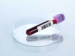 Blood sample in petri dish
