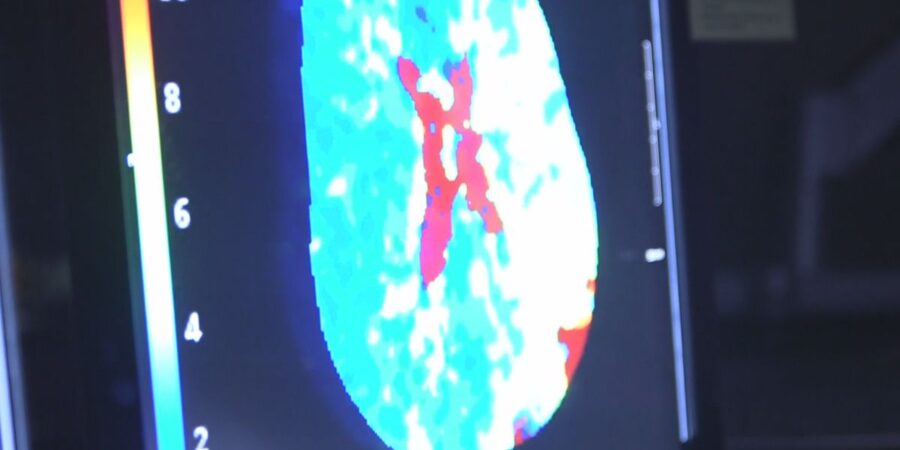 Αγγειακά εγκεφαλικά επεισόδια σχετιζόμενα με λοίμωξη COVID-19 σε νέους ασθενείς