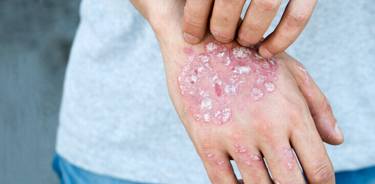 Man scratch oneself, dry flaky skin on hand with psoriasis vulgaris, eczema and other skin conditions like fungus, plaque, rash and patches. Autoimmune genetic disease.