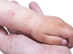 Eczema on the kid’s hand