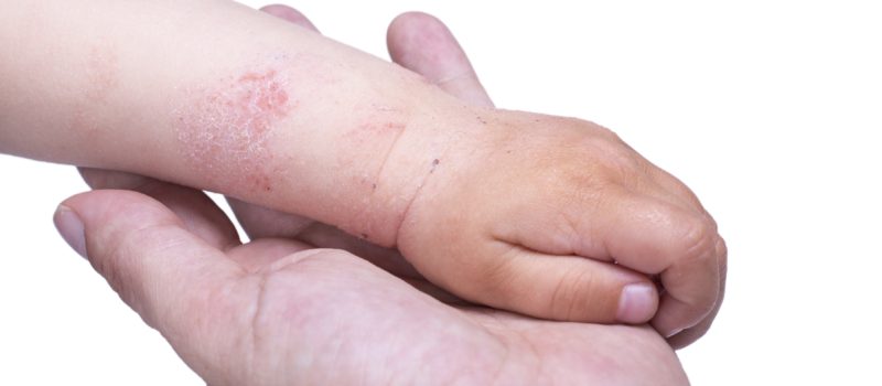Eczema on the kid’s hand