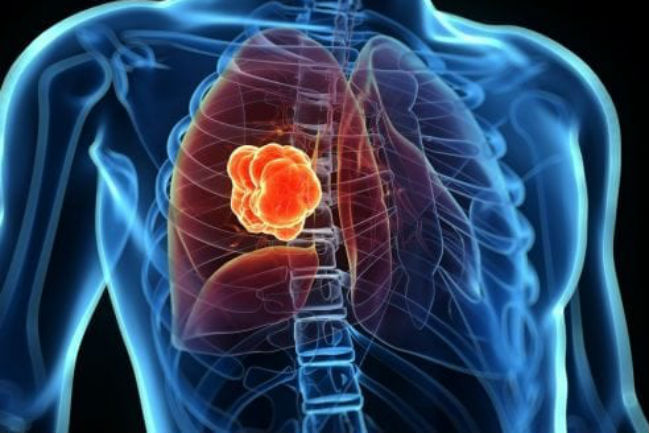 FairLife- Φροντίδα και Πρόληψη για τον καρκίνο του πνεύμονα