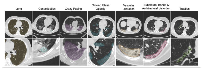 COVID-19: Μελέτη του Ινστιτούτου Humanitas για τη βελτιστοποίηση της διαδικασίας triage
