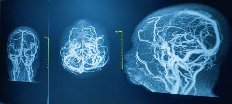 mra-mrv-brain-history-61-year-old-female-presented-with-intracranial-hemorrhage_34251-253