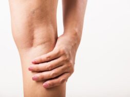 woman-painful-varicose-spider-veins-leg_143683-398