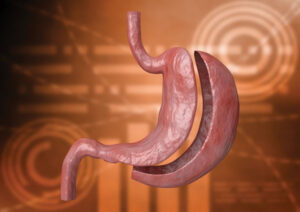 Χειρουργικές τεχνικές αντιμετώπισης της παχυσαρκίας