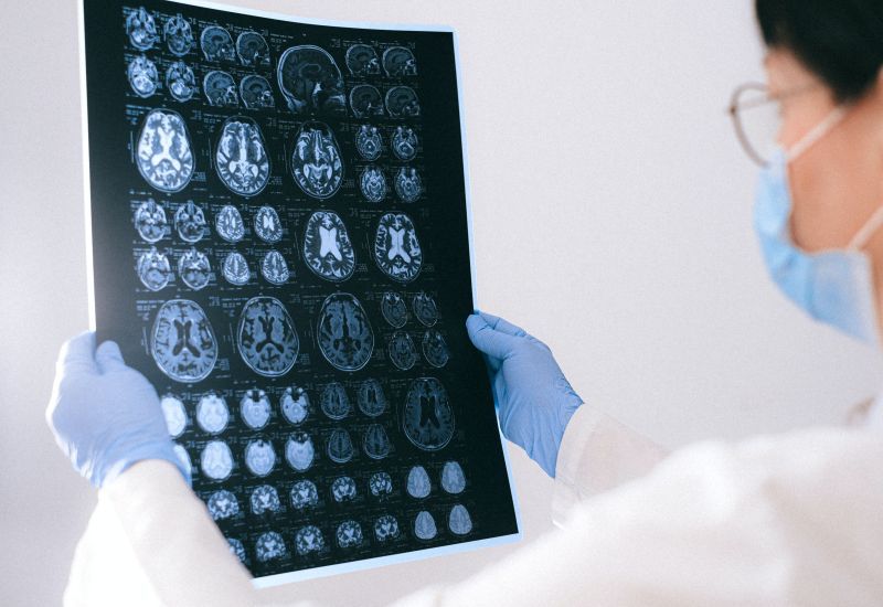 Επιστήμονες ανακάλυψαν συσχέτιση σχιζοφρένειας-ανάπτυξης εγκεφαλικών κυττάρων