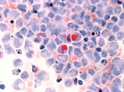 Leukemia_(aml)λ