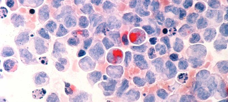 Leukemia_(aml)λ