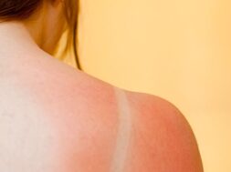 5-ways-to-relieve-sunburn181f1f06149c6502a29dff00004a72eb