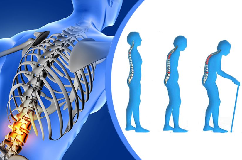 Ραγδαία η αύξηση των καταγμάτων της σπονδυλικής στήλης