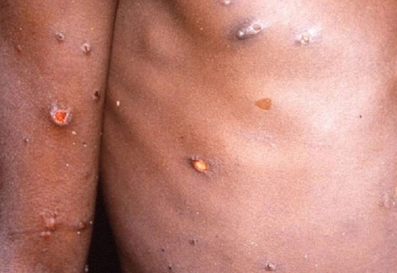 Συναγερμό για την ευλογιά των πιθήκων κήρυξε ο ΠΟΥ