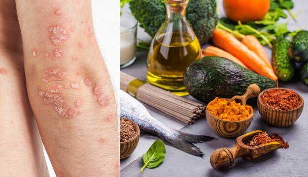 psoriasis-foods-diet-chart-plan