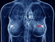 Breast-Cancer