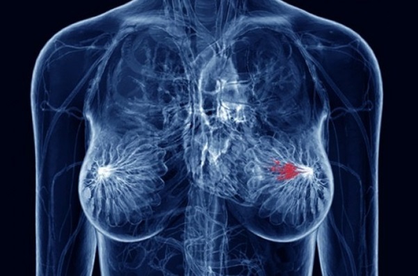 Πρώτη έγκριση στοχεύουσας θεραπείας για ασθενείς με προχωρημένο καρκίνο του μαστού με χαμηλή έκφραση HER2