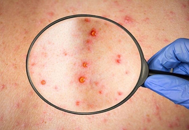 ΕΟΔΥ: 50 τα κρούσματα ευλογιάς των πιθήκων στη χώρα μας – Όλοι άντρες