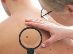 27588-melanoma-new_660