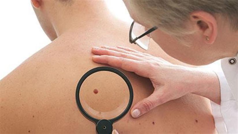 Νέα θεραπεία του ανεγχείρητου ή μεταστατικού μελανώματος με συνδυασμό φαρμάκων