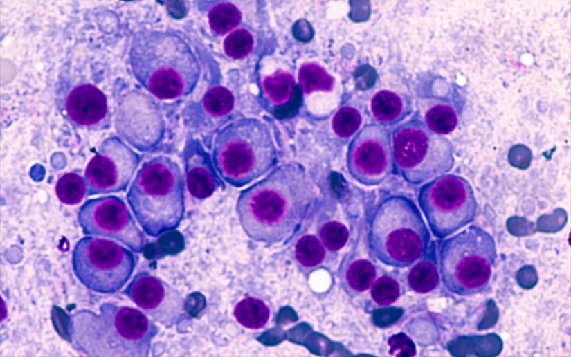 Συνέδριο για το πολλαπλούν μυέλωμα στο Λος Άντζελες