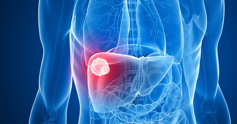 Αύξηση των περιστατικών καρκίνου του ήπατος κατά 60% μες τα επόμενα χρόνια