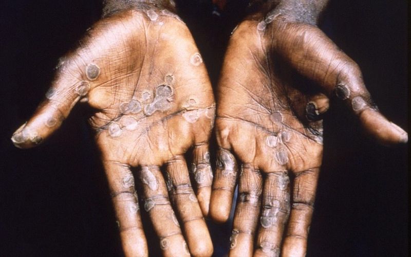 Πάνω από 70.000 τα κρούσματα της ευλογιάς των πιθήκων παγκοσμίως, σύμφωνα με τον ΠΟΥ