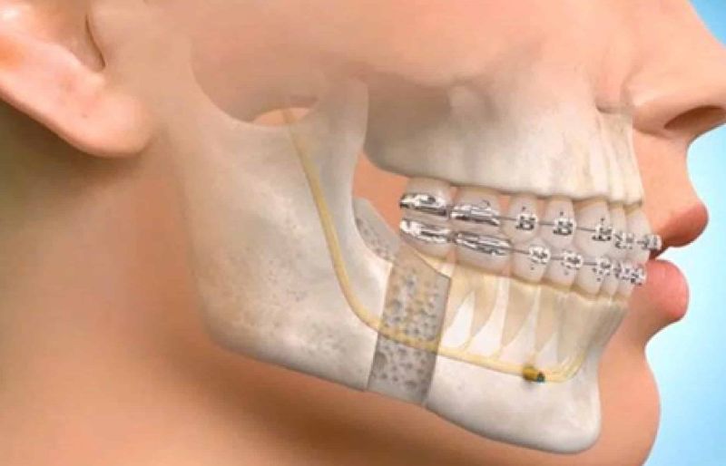 Ελληνική Εταιρεία Στοματικής και Γναθοπροσωπικής Χειρουργικής: Κατακόρυφη αύξηση των κρανιογναθοπροσωπικών τραυμάτων
