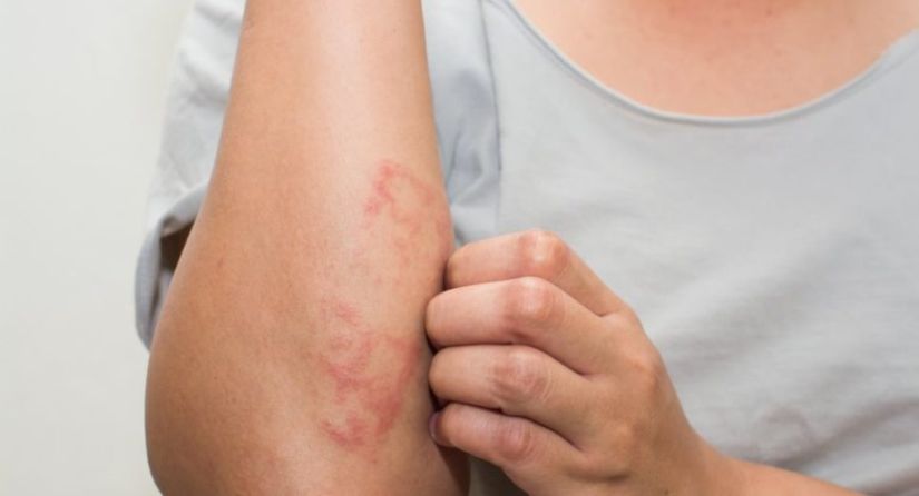 Παγκόσμια Ημέρα Ψωρίασης – Ενωμένοι αντιμετωπίζουμε την Ψυχική Υγεία