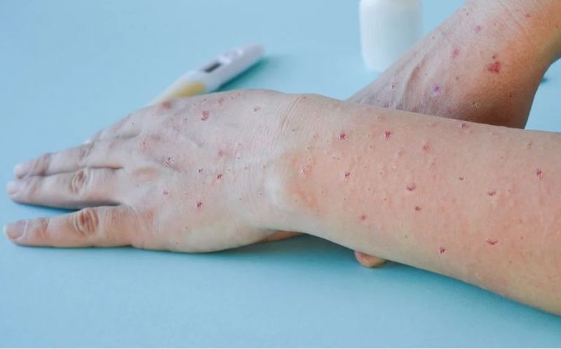 Η ευλογιά των πιθήκων μεταδίδεται πριν την εκδήλωση των συμπτωμάτων, σύμφωνα με νέα έρευνα