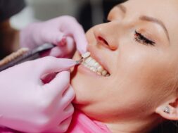 dental-veneer