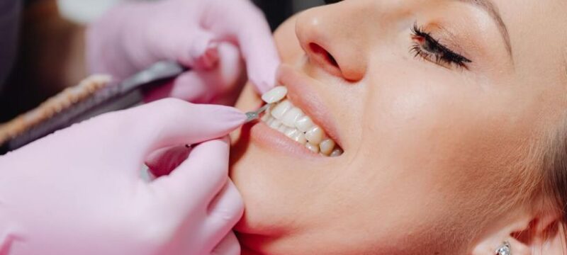 dental-veneer
