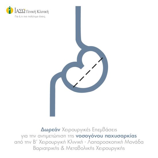 ΙΑΣΩ Γενική Κλινική: Δωρεάν Χειρουργικές Επεμβάσεις για την αντιμετώπιση της Νοσογόνου Παχυσαρκίας