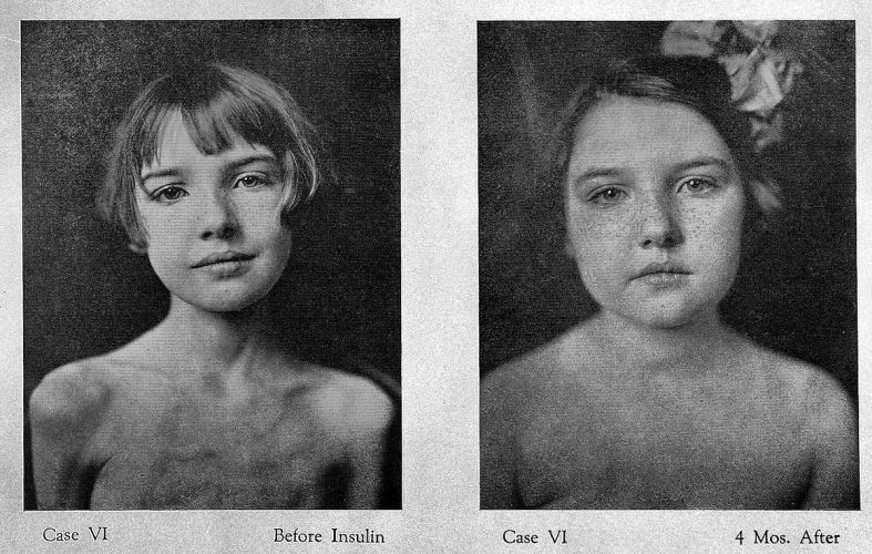 Frederick Banting: «Η ινσουλίνη δεν ανήκει σε εμένα, ανήκει στον κόσμο»