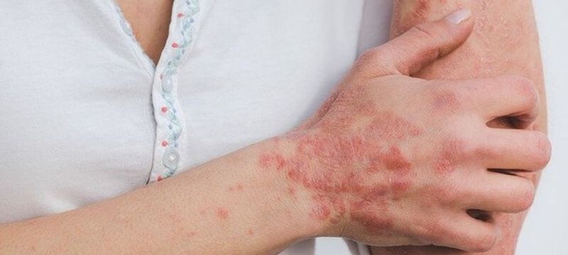 psoriasis