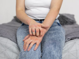 hands-patient-suffering-from-psoriasis
