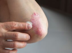 psoriasis-elbow