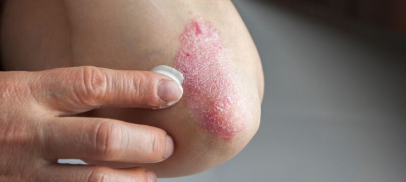 psoriasis-elbow