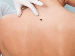 Καρκίνος-Δέρματος-–-Μελάνωμα-8-Μαίου-
