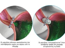 επέμβαση-linx—τρόπος-λειτουργίας