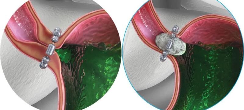 επέμβαση-linx—τρόπος-λειτουργίας