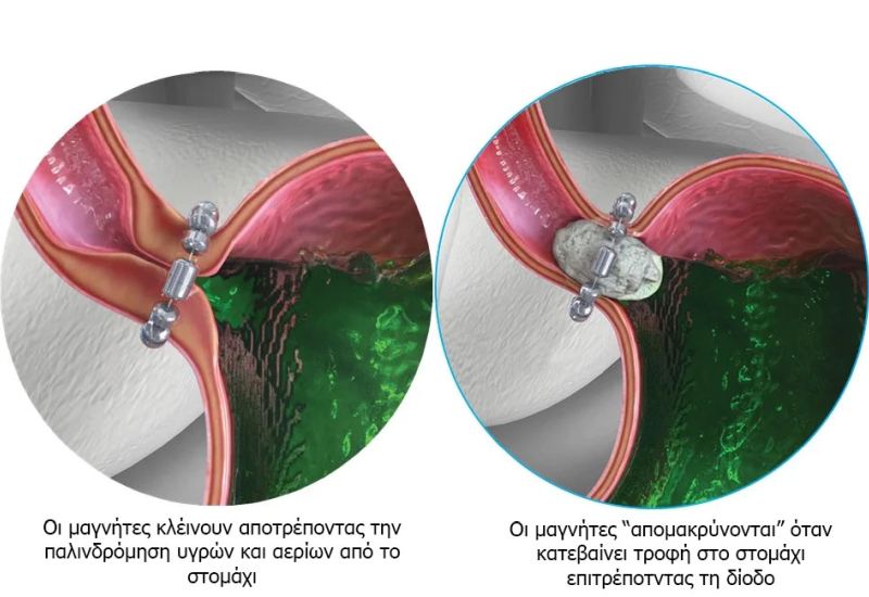 Επέμβαση LINΧ: Νέα, ελάχιστα επεμβατική μέθοδος για την οριστική αντιμετώπιση της Γαστροοισοφαγικής Παλινδρόμησης