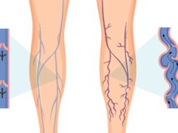 Human legs with varicose vein
