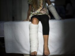 Young Caucasian girl with broken leg in plaster cast
