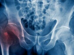 850-HIP-FRACTURE-GettyImages-955273978