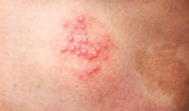 Woman leg skin background with rash from herpes zoster or shingles disease