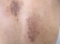 Cutaneous amyloidosis on the back of an elderly man