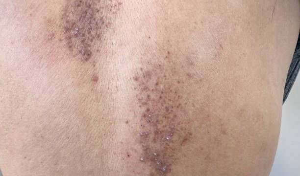 Cutaneous amyloidosis on the back of an elderly man